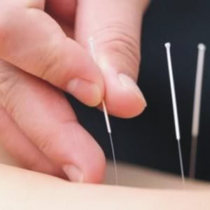 Acupuntura  (inclui: Fitoterapia, Aromaterapia, Aurículo, Ventosa e Massagem nas costas)